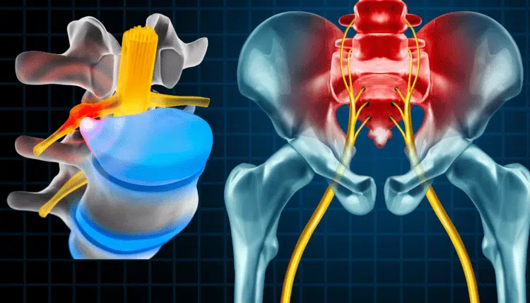 Disc Herniation